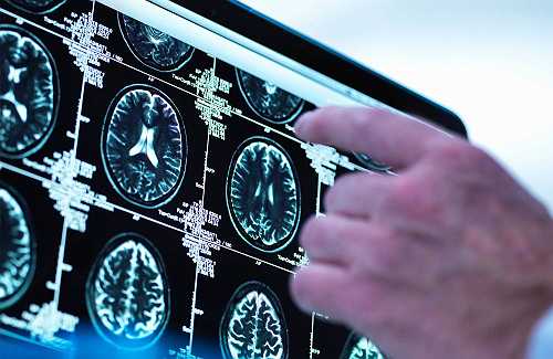 AI proves 'twice as accurate' in predicting strokes